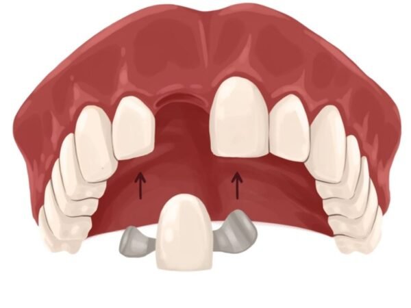 What is a Maryland Bridge? Cost, Procedure, Pros & Cons