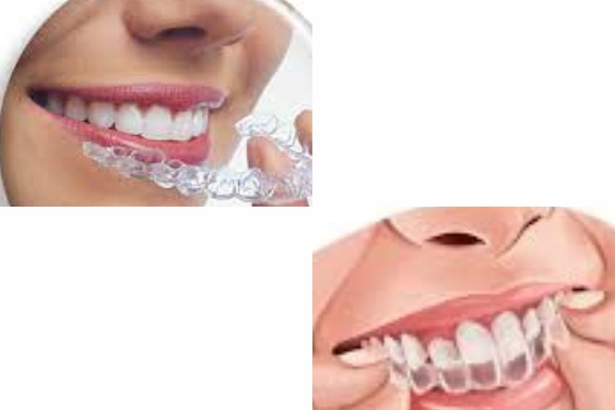 How Much Is Invisalign in California? Factors, Locations & Discounts
